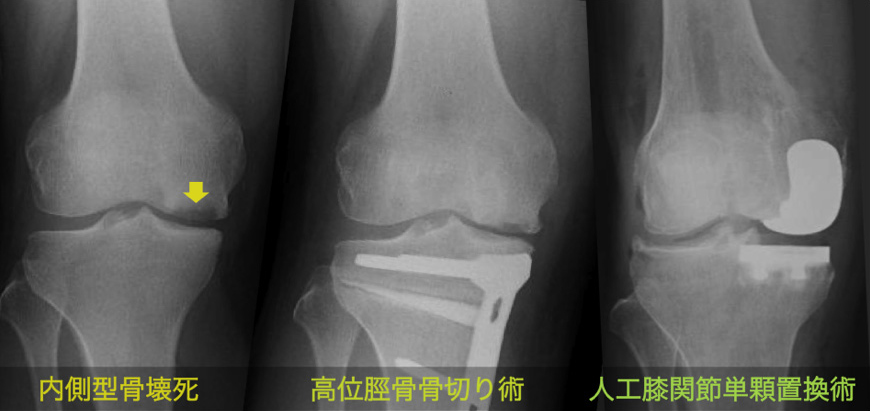 高位脛骨骨切り術と人工膝関節単顆置換術
