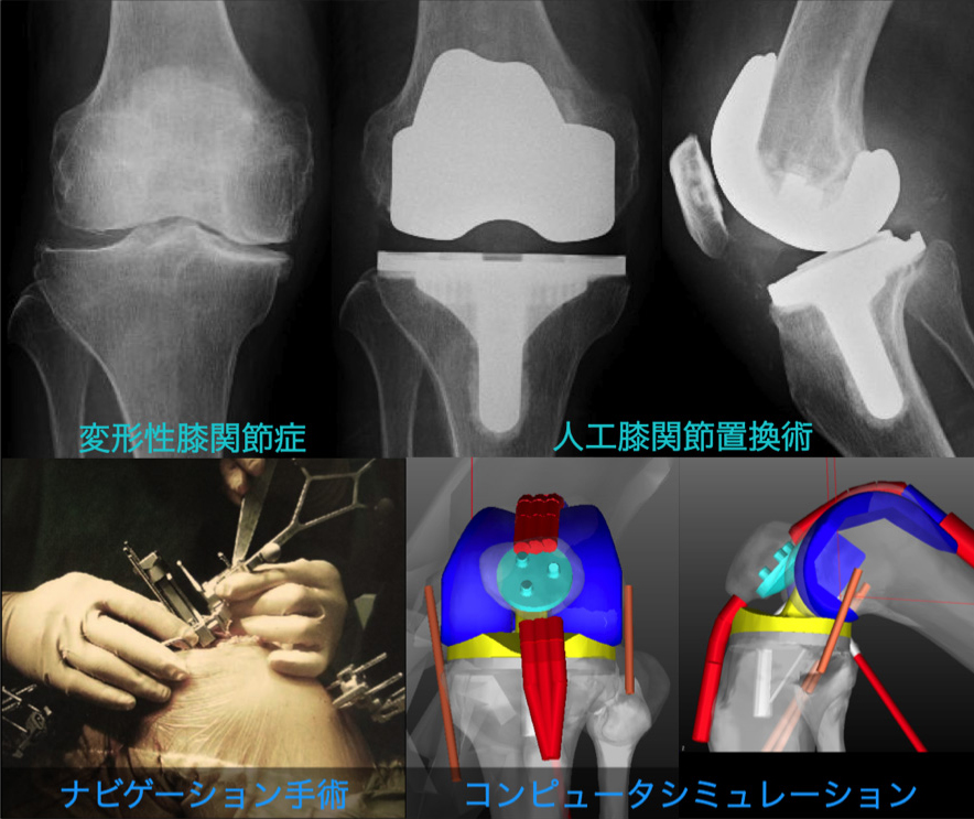 人工膝関節全置換術